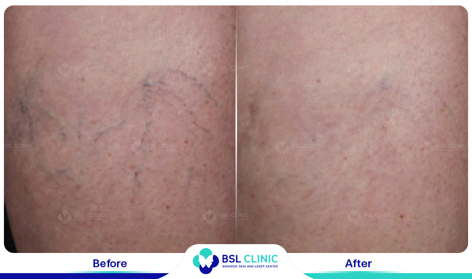 result Facial Redness (Rosacea) Red Birthmarks Spider and Leg Veins