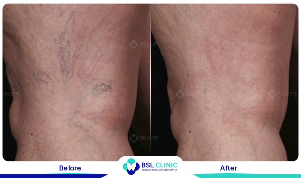 result Facial Redness (Rosacea) Red Birthmarks Spider and Leg Veins
