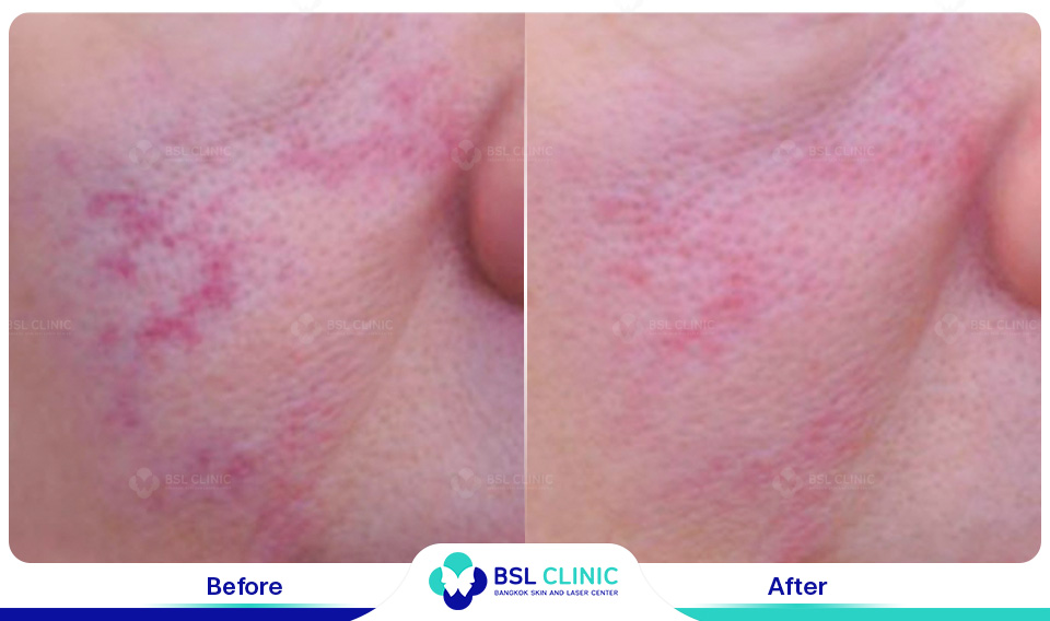 result Facial Redness (Rosacea) Red Birthmarks Spider and Leg Veins