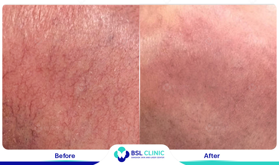 result Facial Redness (Rosacea) Red Birthmarks Spider and Leg Veins