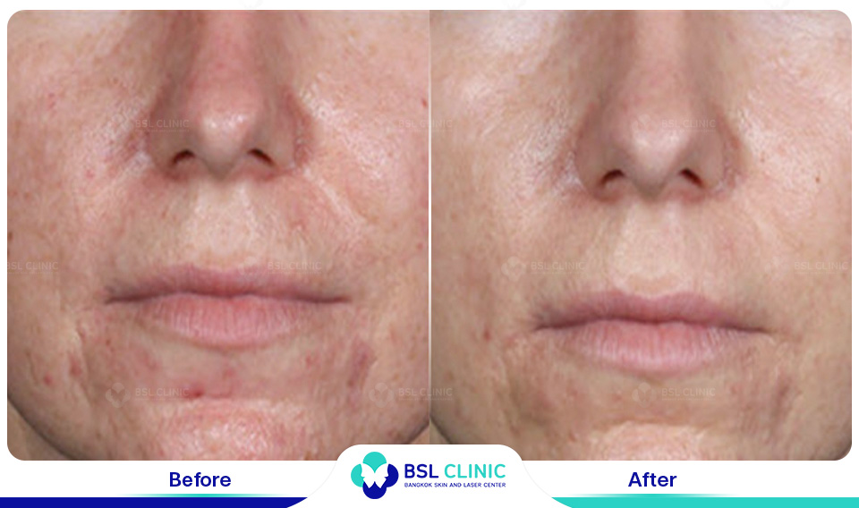 result Facial Redness (Rosacea) Red Birthmarks Spider and Leg Veins