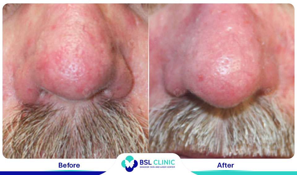 result Facial Redness (Rosacea) Red Birthmarks Spider and Leg Veins