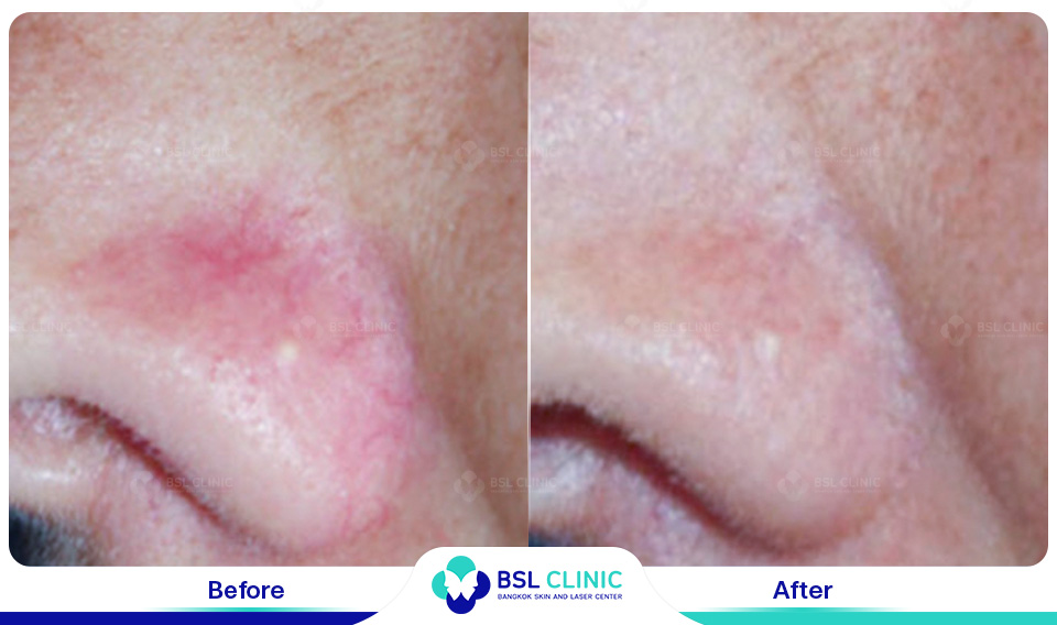 result Facial Redness (Rosacea) Red Birthmarks Spider and Leg Veins
