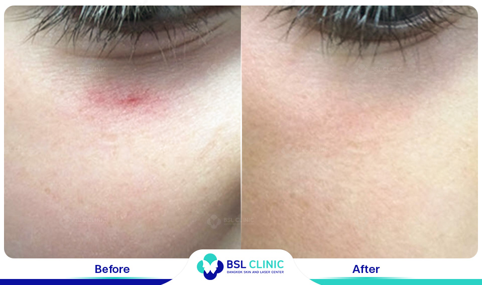 result Facial Redness (Rosacea) Red Birthmarks Spider and Leg Veins