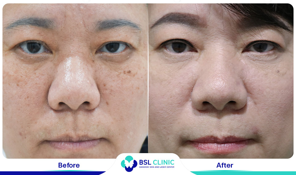 result CO2 Laser