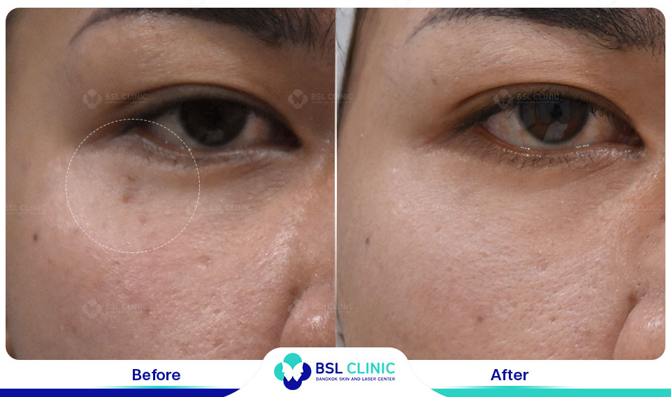 result CO2 Laser