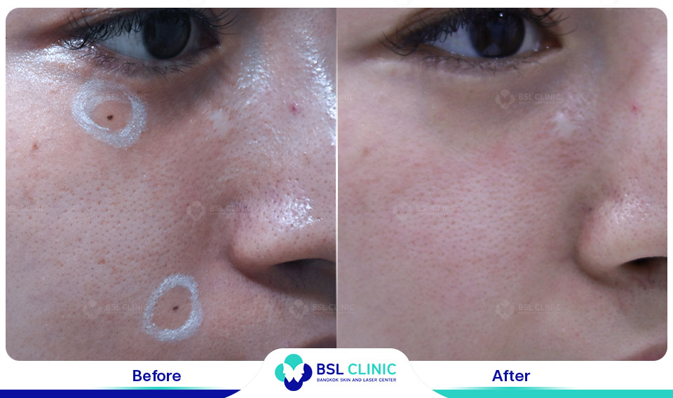 result CO2 Laser