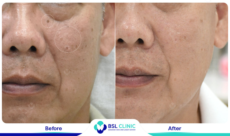 result CO2 Laser