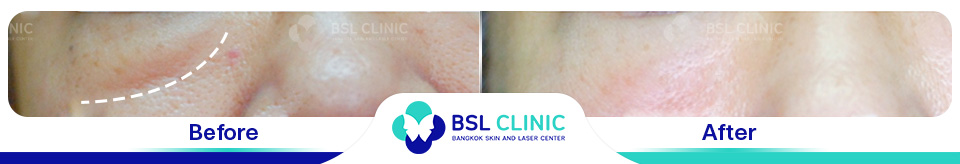 result Eyes Wrinkle, Dark Circle, Eyes Bag, Droopy Eyelid