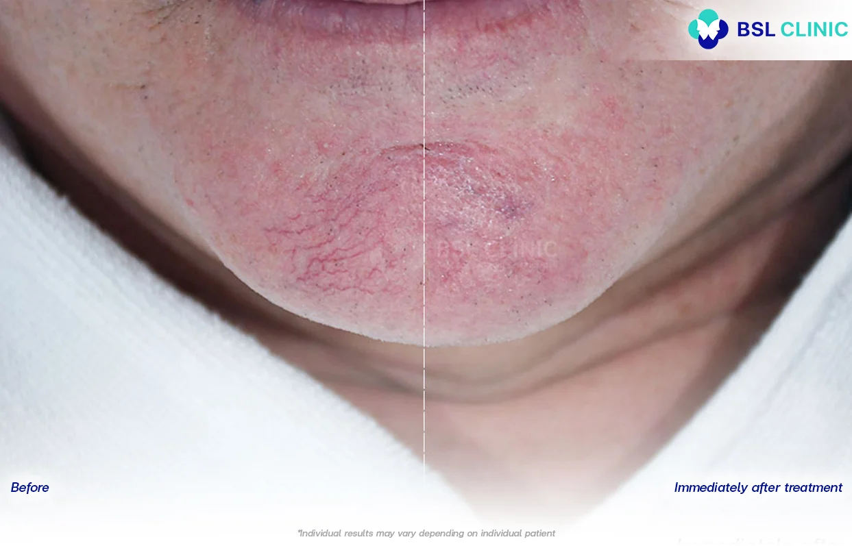 result Facial Redness (Rosacea) Red Birthmarks Spider and Leg Veins