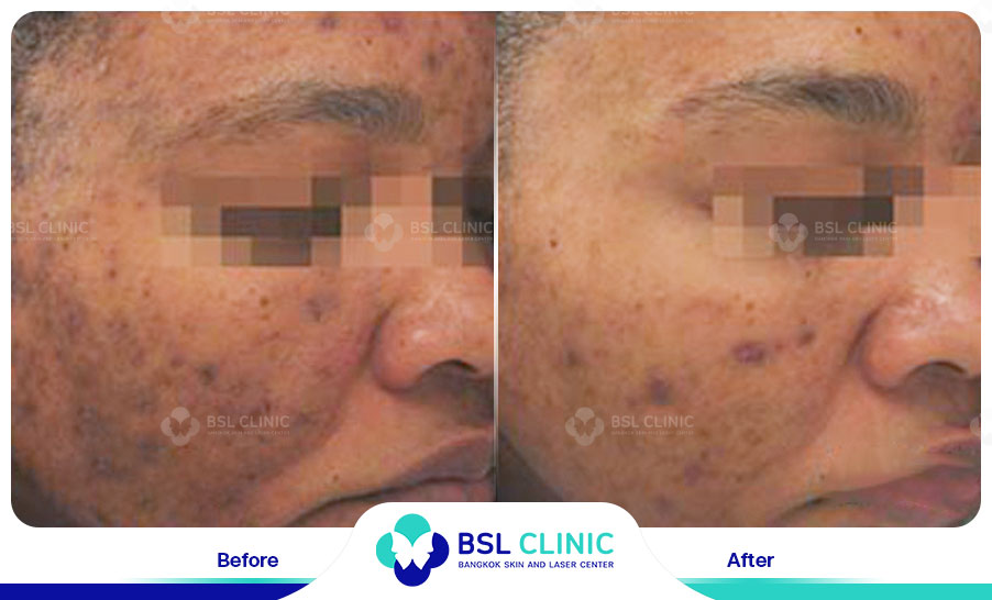 result Fractora laser
