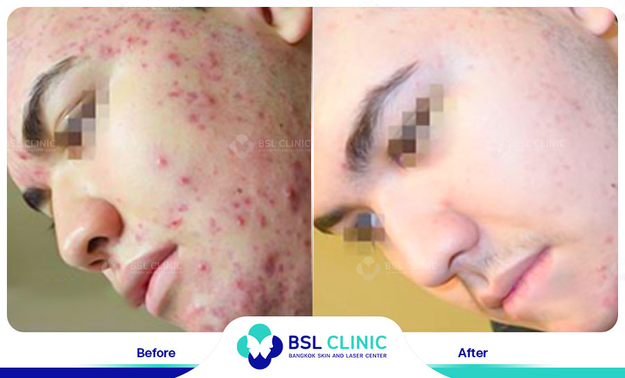 result Fractora laser