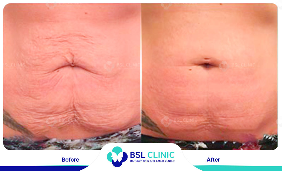 result Fractora laser