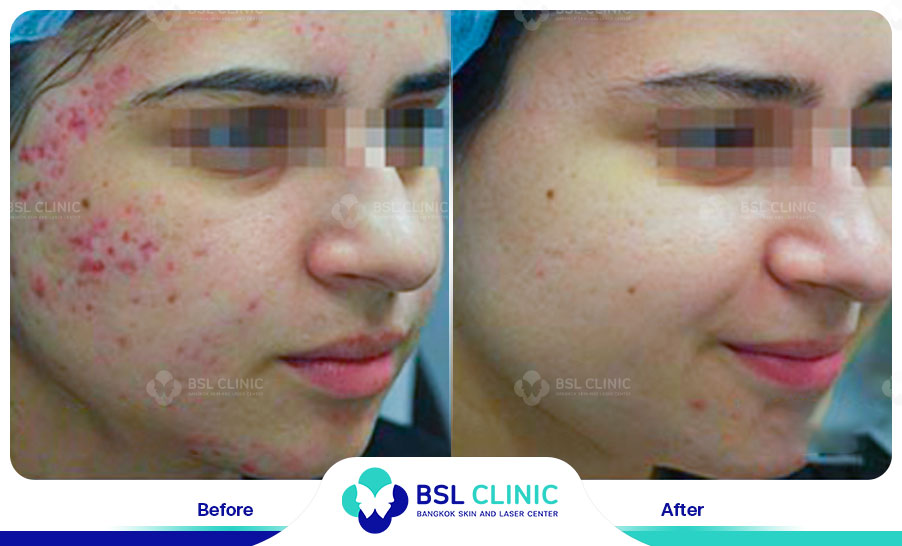 result Fractora laser