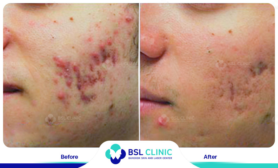 result Fractora laser