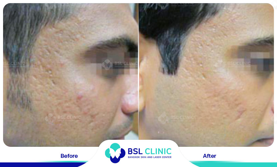 result Fractora laser