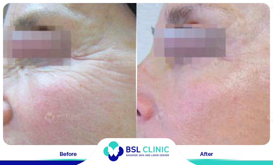 result Fractora laser
