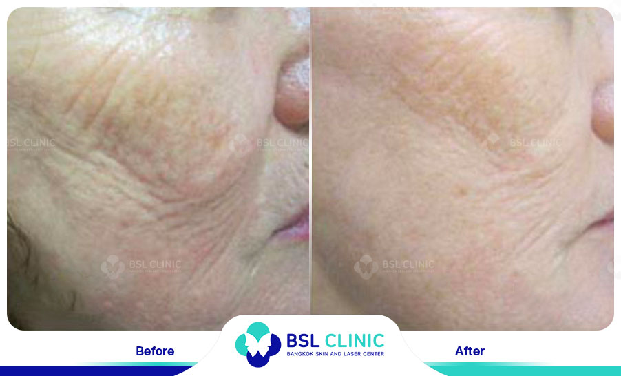 result Fractora laser