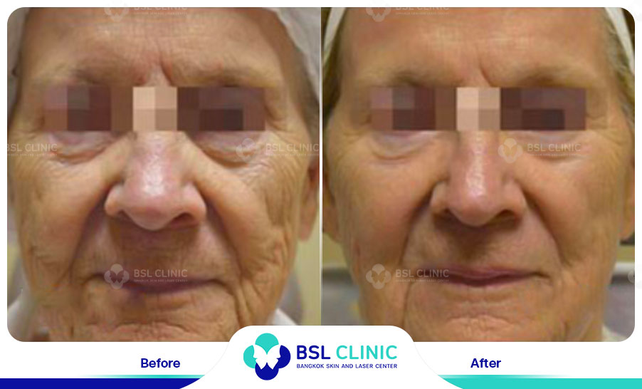 result Fractora laser