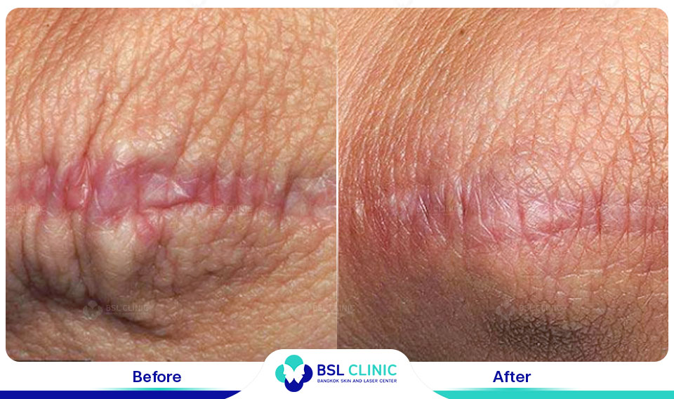 before after scars