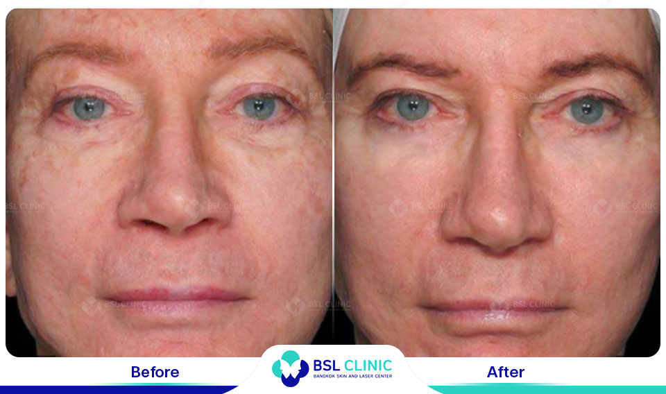 before and after pigmentation improvement with fraxel dual resurfacing laser treatment showing reduced dark spots and even skin tone from fraxel laser treatment at fraxel laser bangkok