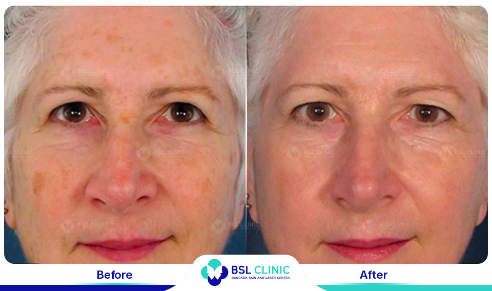 before and after facial pigmentation correction using fraxel dual resurfacing laser dual fraxel laser wavelength technology supporting clearer skin after laser treatment in bangkok