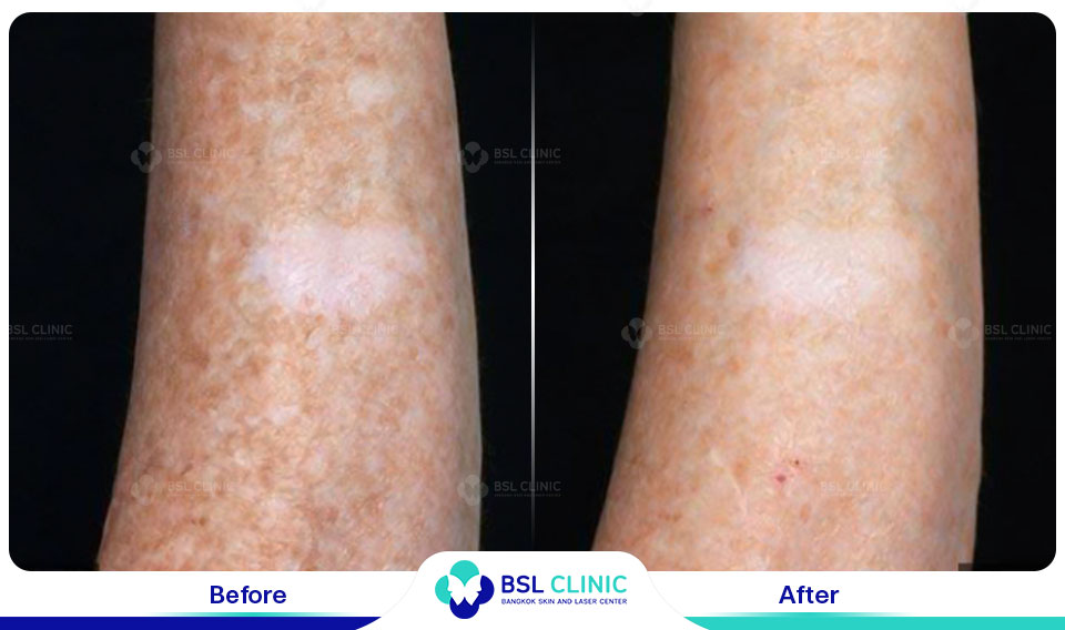 before and after hyperpigmentation reduction with fraxel dual laser treatment fraxel laser wavelength targeting uneven skin tone and sun damage at fraxel laser bangkok clinic