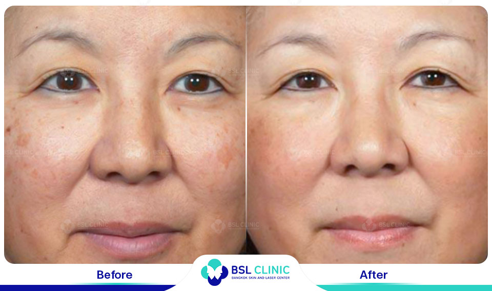 before-and-after-age-spot-and-melasma-appearance-improvement-with-fraxel-dual-resurfacing-laser-treatment-showing-smoother-and-brighter-skin-from-fraxel-laser-treatment