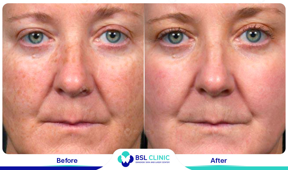 before and after pigmented skin texture refinement with fraxel dual resurfacing laser dual fraxel laser wavelength supporting even complexion after laser treatment in bangkok