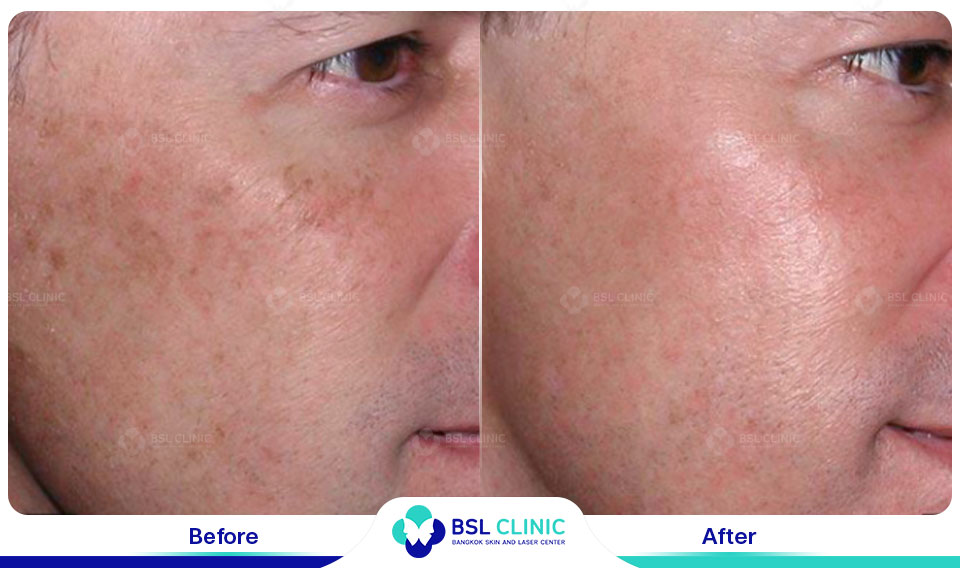 before and after uneven skin tone and pigmentation care using fraxel dual resurfacing laser treatment fraxel laser technology for overall skin clarity at fraxel laser bangkok