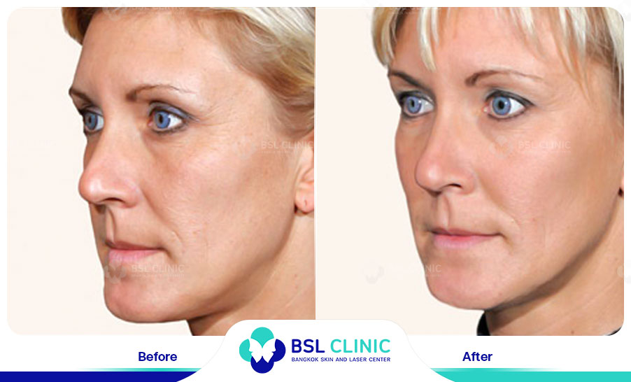 result HA filler belotero