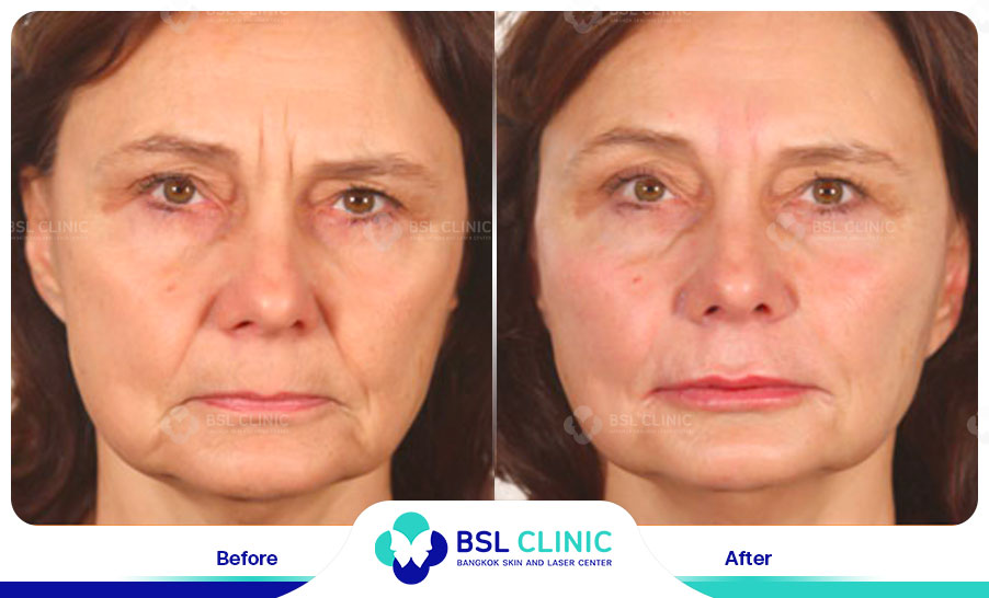 result HA filler belotero