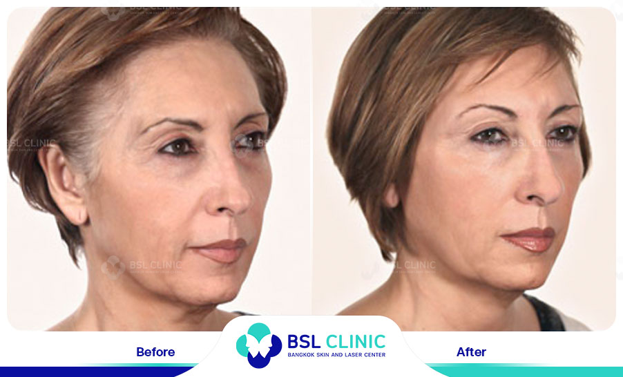 result HA filler belotero