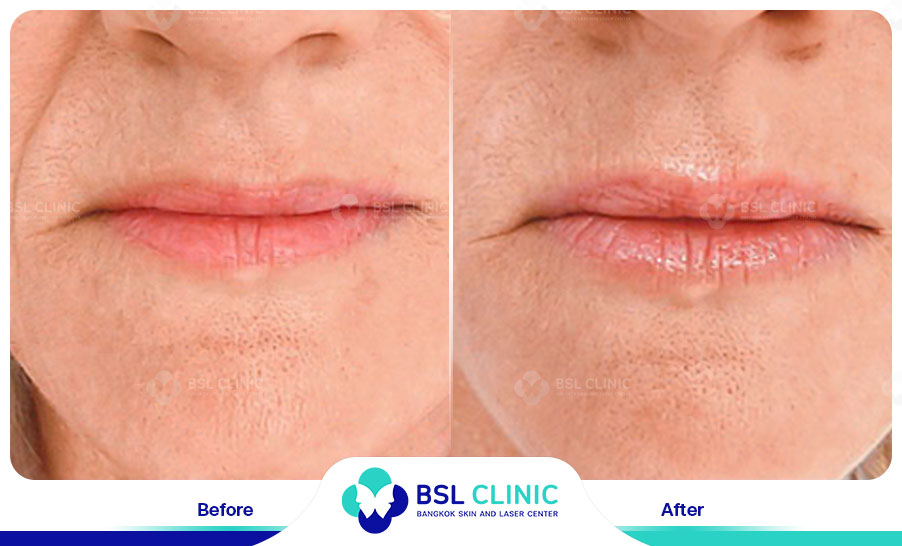 result HA filler belotero