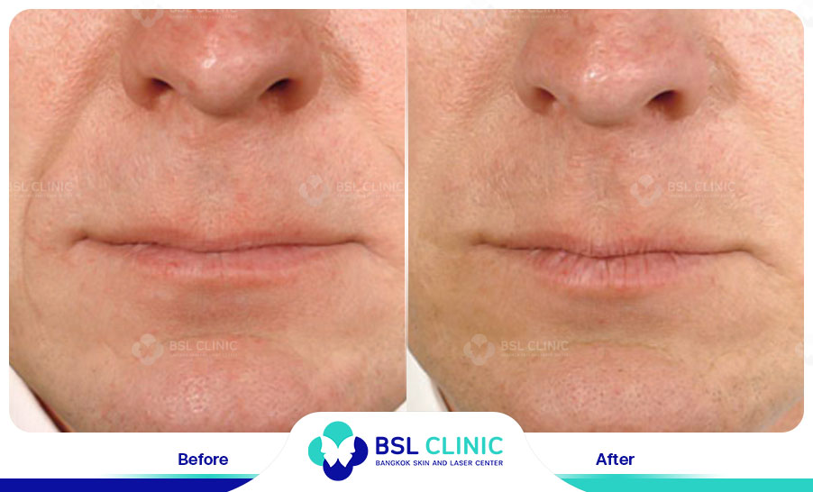 result HA filler belotero
