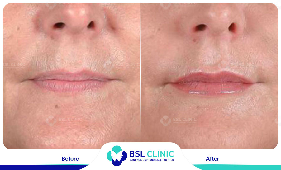 result HA filler belotero