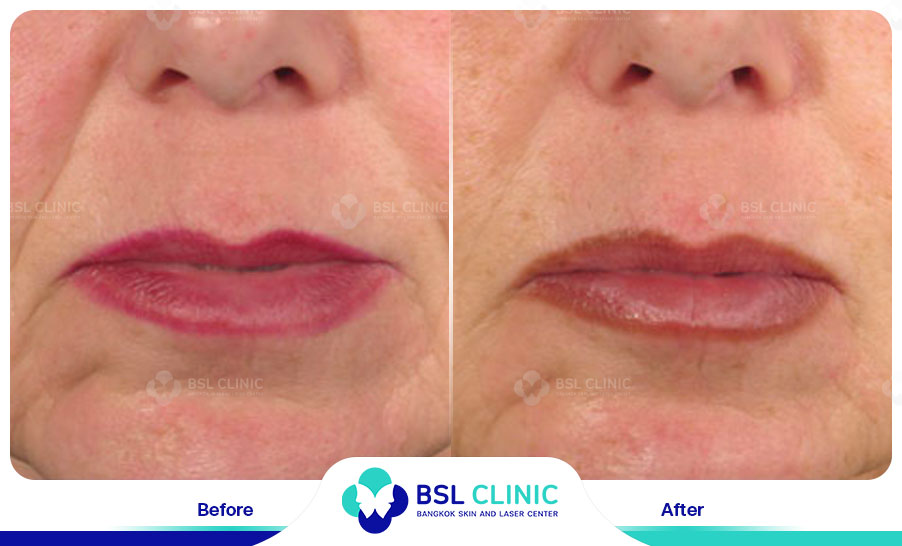 result HA filler belotero