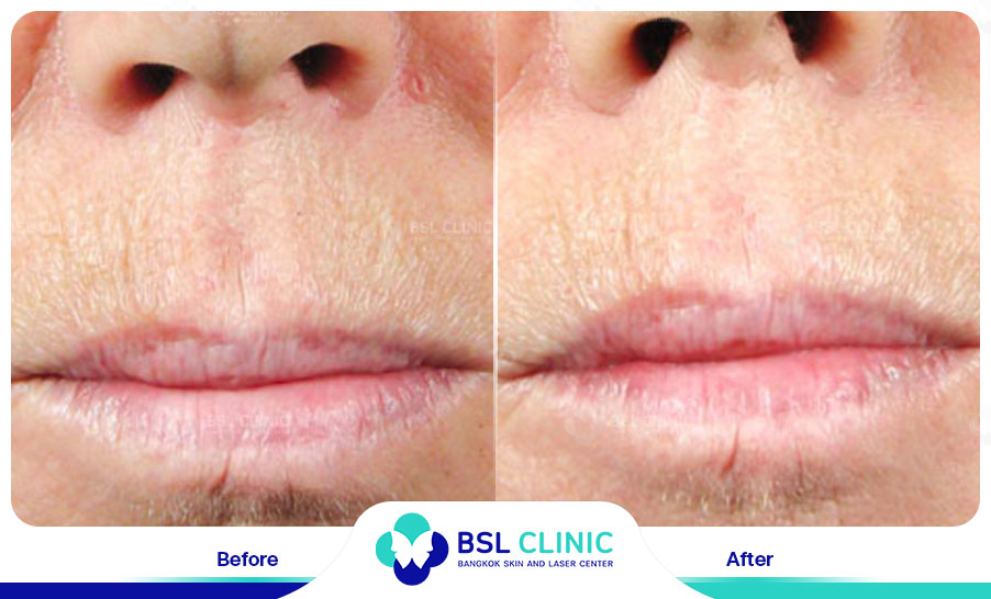 result HA filler belotero