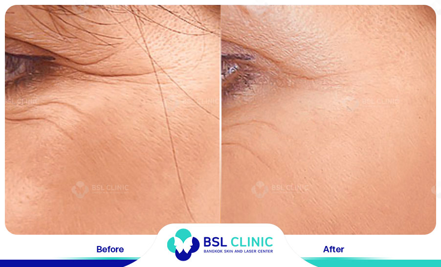 result HA filler belotero
