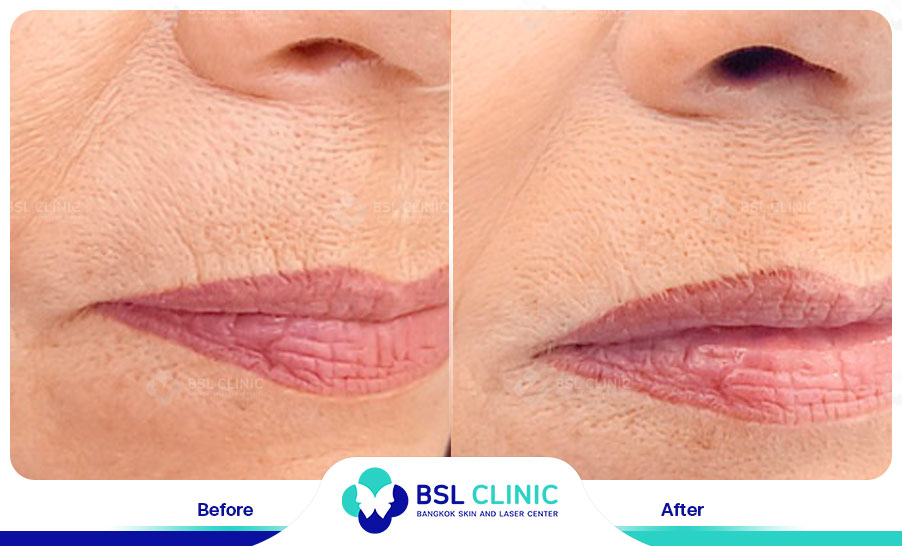 result HA filler belotero