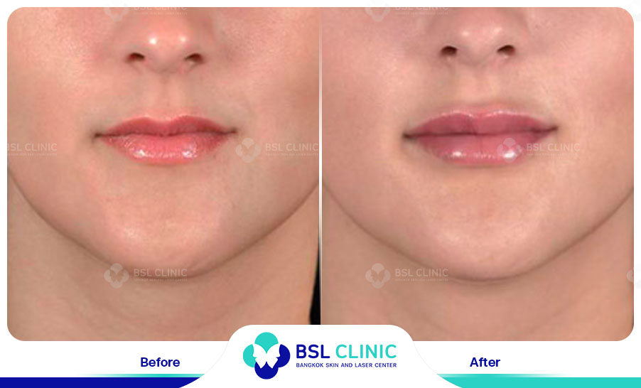 result HA filler belotero