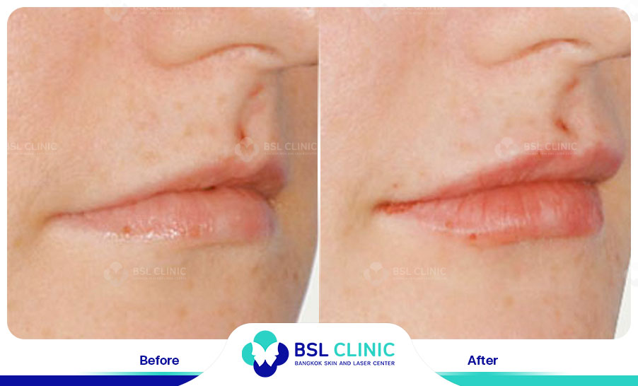 result HA filler belotero