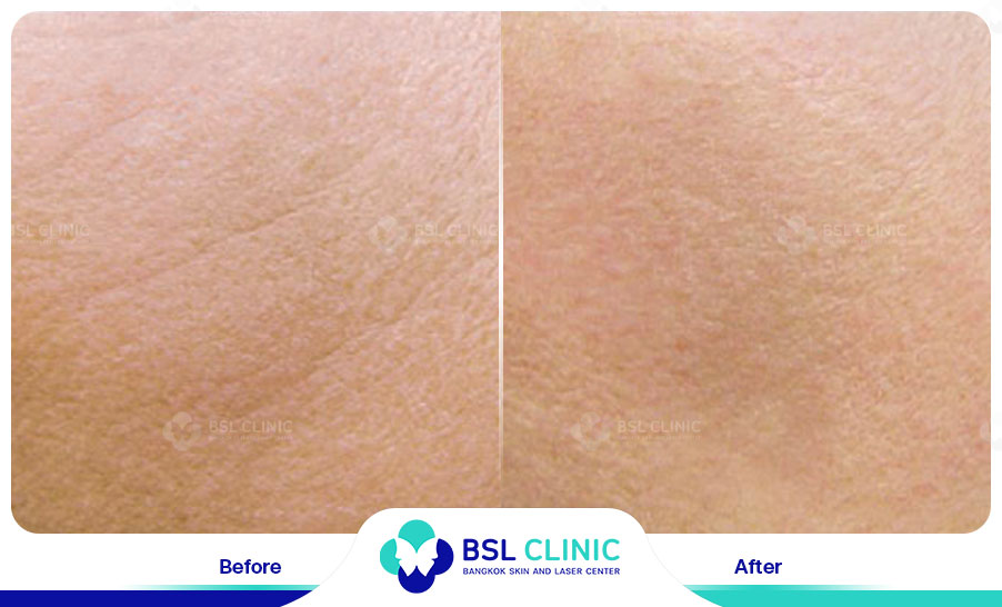 result HA filler belotero