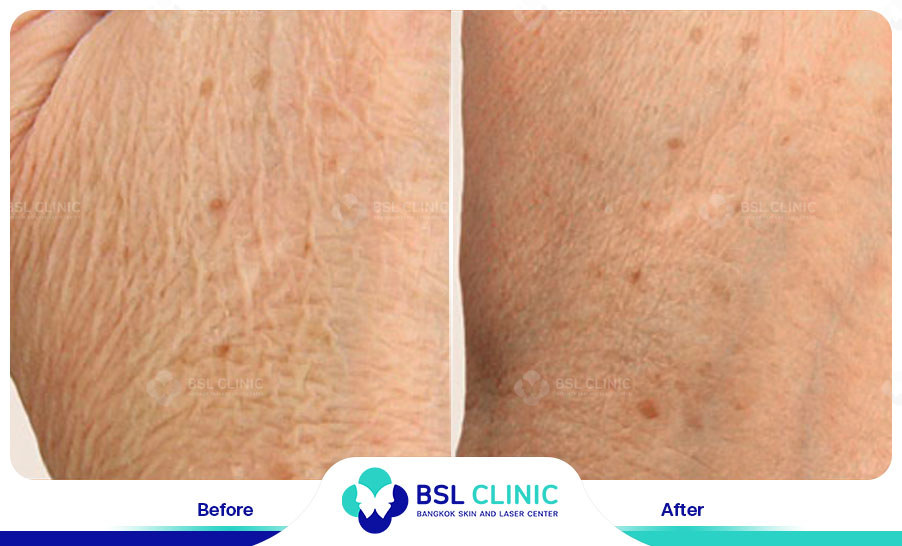 result HA filler belotero