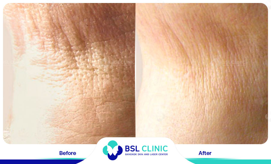 result HA filler belotero