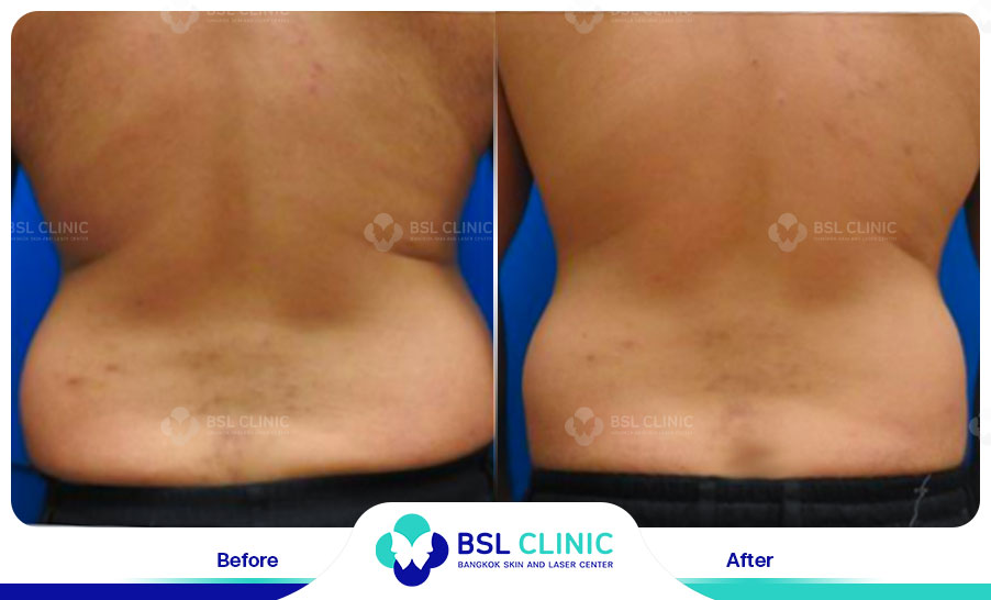 result Skin Tightening Alma TitenFX02