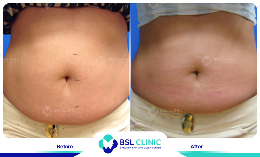 result Skin Tightening Alma TitenFX02