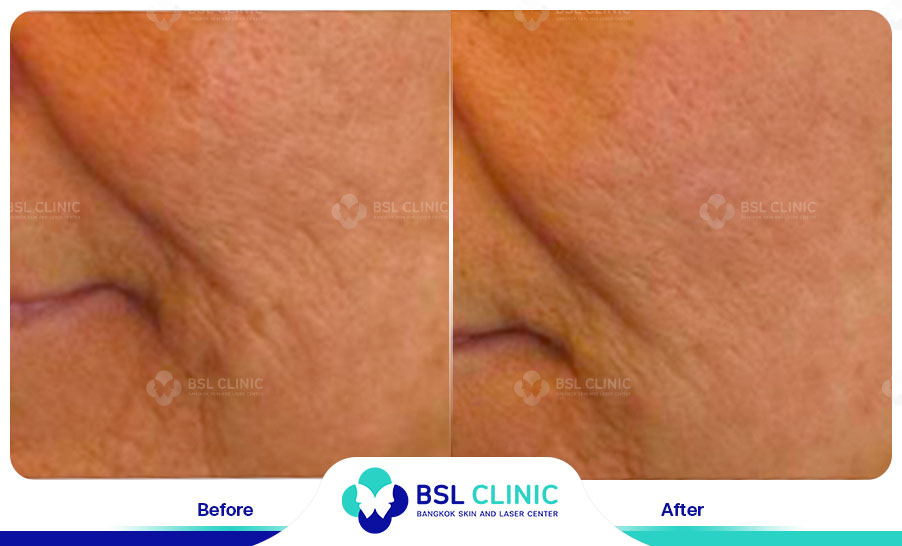 result Skin Tightening Alma TitenFX02