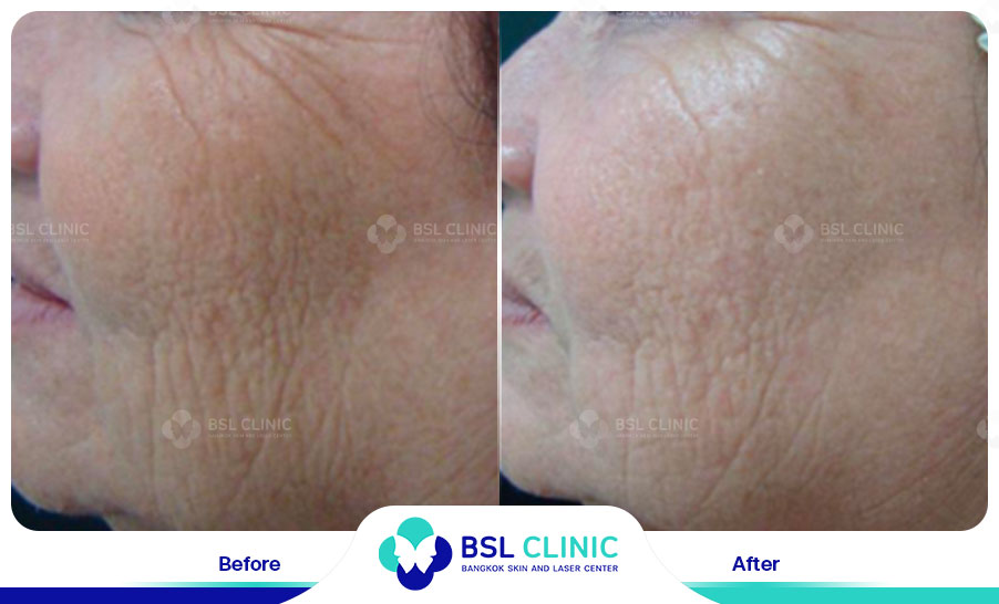 result Skin Tightening Alma TitenFX02