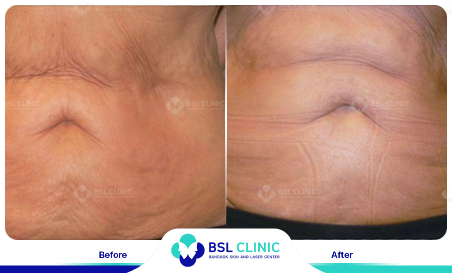 result Skin Tightening Alma TitenFX02